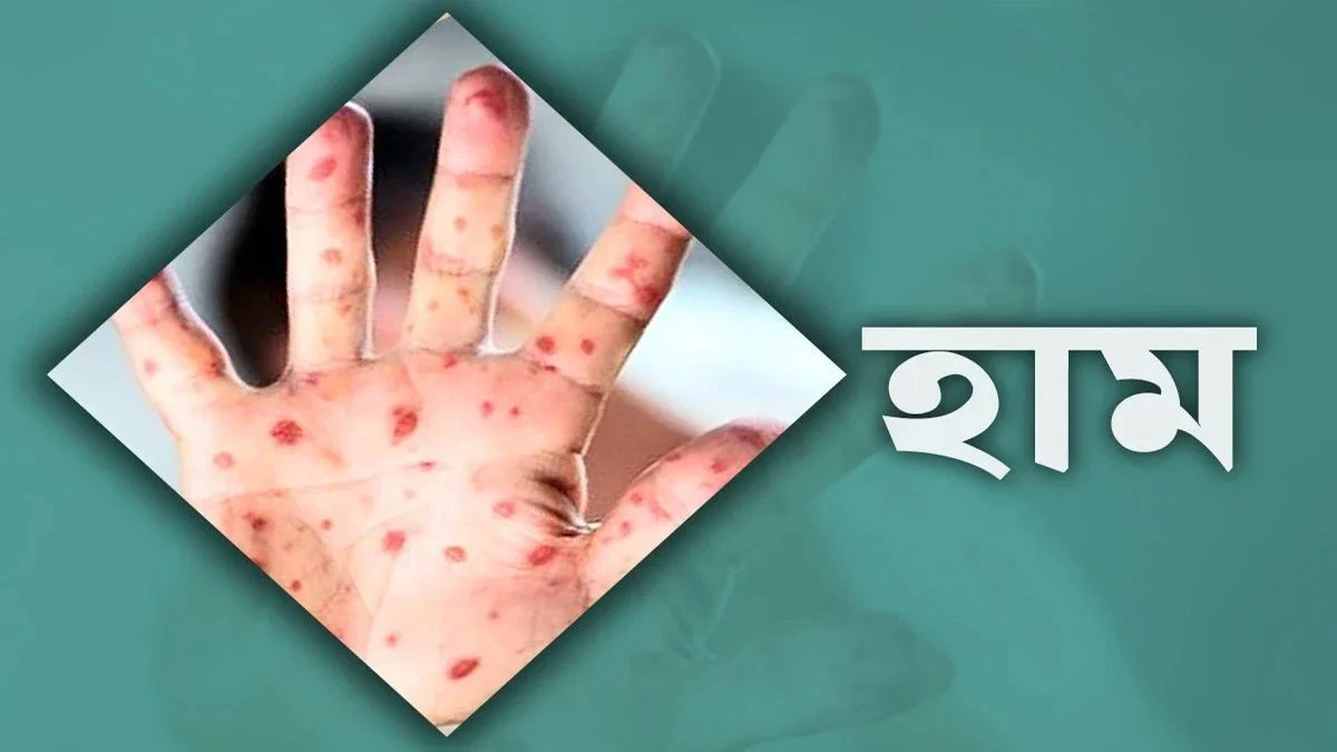 হামে আক্রান্ত হয়ে গত দেড় মাসে ২৬৪ শিশুর মৃত্যু হয়েছে। প্রতীকী ছবি